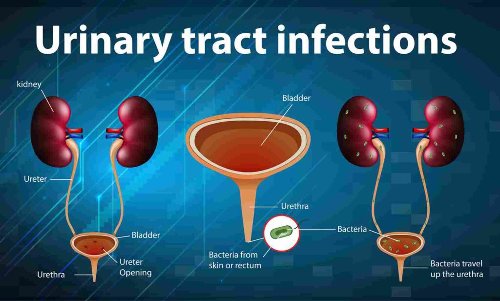 5 Reasons Why Aimil Neeri Kft Syrup Sugar Free is the Perfect Solution for Urinary Health